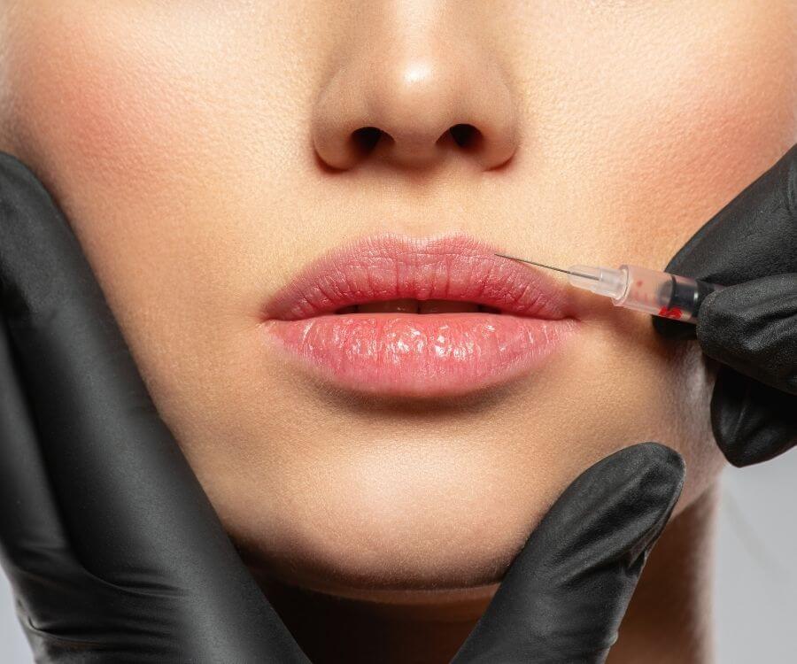 Dudak Kaldırma (Lip Lift) Ameliyatı